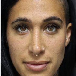 Photo Facial Before & After Patient #1209