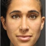 Photo Facial Before & After Patient #1209