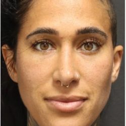 Photo Facial Before & After Patient #1209