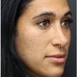 Photo Facial Before & After Patient #1209