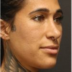 Photo Facial Before & After Patient #1209