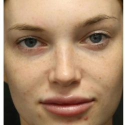 Photo Facial Before & After Patient #1208