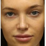 Photo Facial Before & After Patient #1208