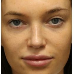Photo Facial Before & After Patient #1208