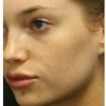Photo Facial Before & After Patient #1208