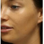 Photo Facial Before & After Patient #1208
