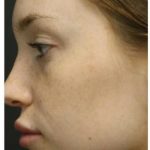 Photo Facial Before & After Patient #1208