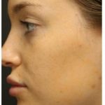 Photo Facial Before & After Patient #1208