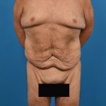 Post-Bariatric Surgery Before & After Patient #1314