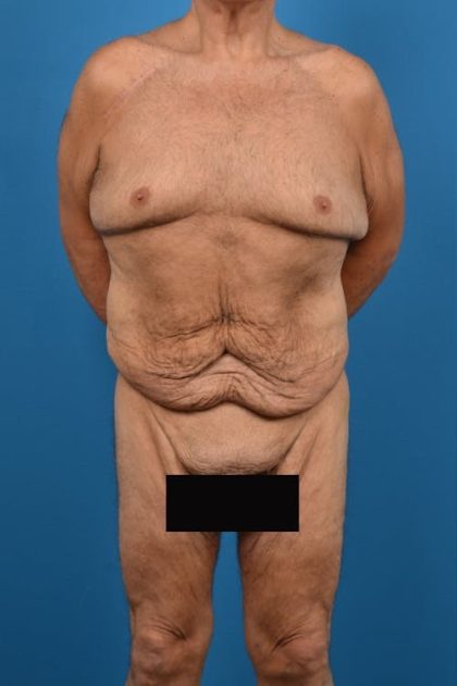 Post-Bariatric Surgery Before & After Patient #1314