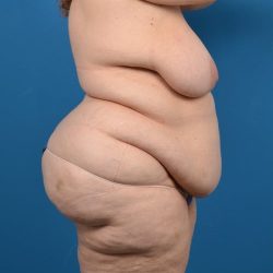 Post-Bariatric Surgery Before & After Patient #1313