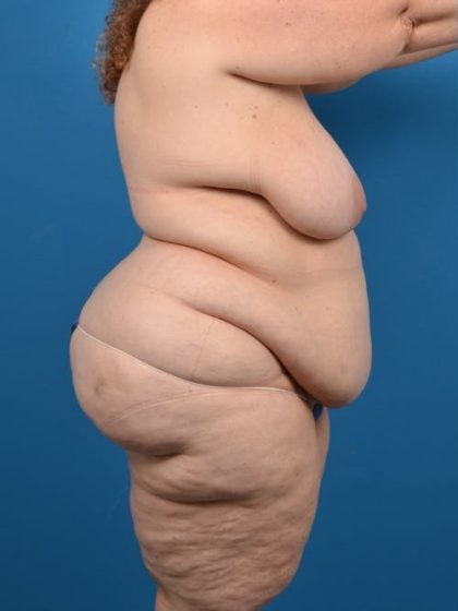 Post-Bariatric Surgery Before & After Patient #1313