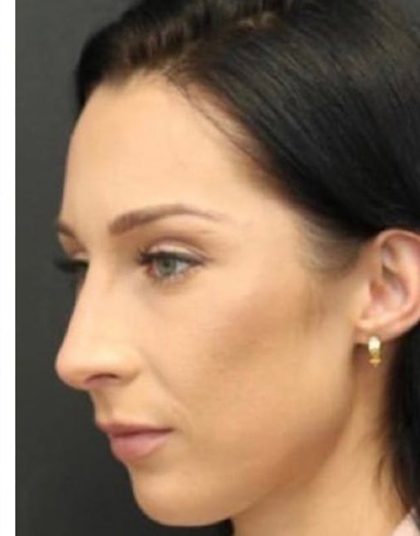 Rhinoplasty Before & After Patient #1223