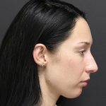 Rhinoplasty Before & After Patient #1223
