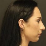 Rhinoplasty Before & After Patient #1223
