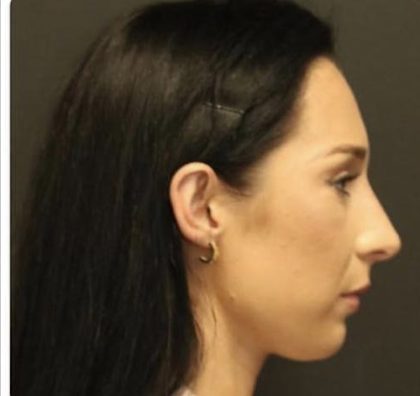 Rhinoplasty Before & After Patient #1223