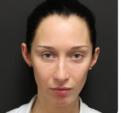 Rhinoplasty Before & After Patient #1223