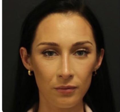 Rhinoplasty Before & After Patient #1223