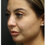 Rhinoplasty Before & After Patient #1221