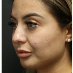 Rhinoplasty Before & After Patient #1221