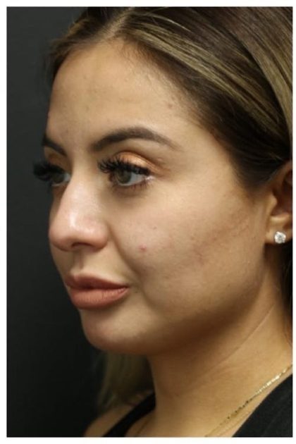 Rhinoplasty Before & After Patient #1221