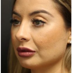 Rhinoplasty Before & After Patient #1221