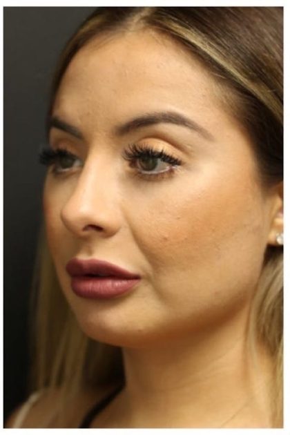 Rhinoplasty Before & After Patient #1221