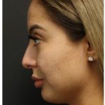 Rhinoplasty Before & After Patient #1221