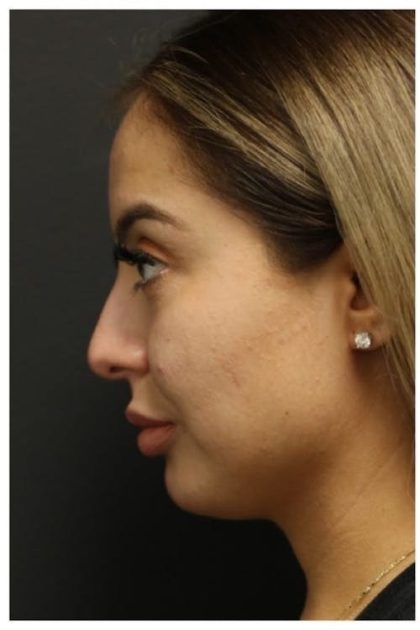 Rhinoplasty Before & After Patient #1221