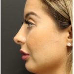 Rhinoplasty Before & After Patient #1221