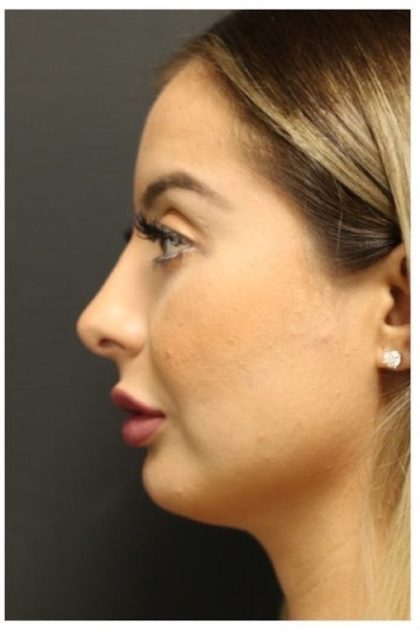 Rhinoplasty Before & After Patient #1221