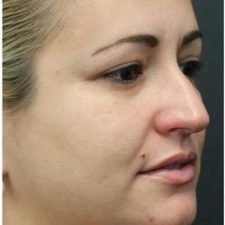 Rhinoplasty Before & After Patient #1220
