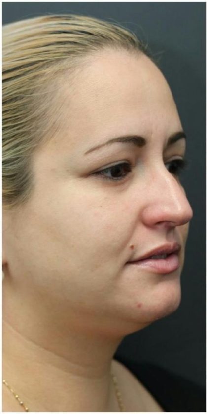 Rhinoplasty Before & After Patient #1220