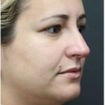 Rhinoplasty Before & After Patient #1220