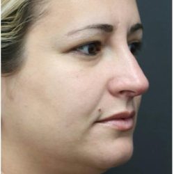 Rhinoplasty Before & After Patient #1220