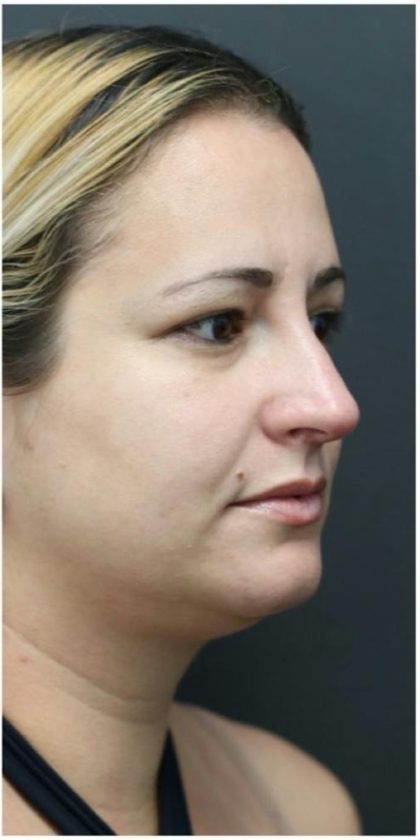 Rhinoplasty Before & After Patient #1220