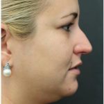 Rhinoplasty Before & After Patient #1220