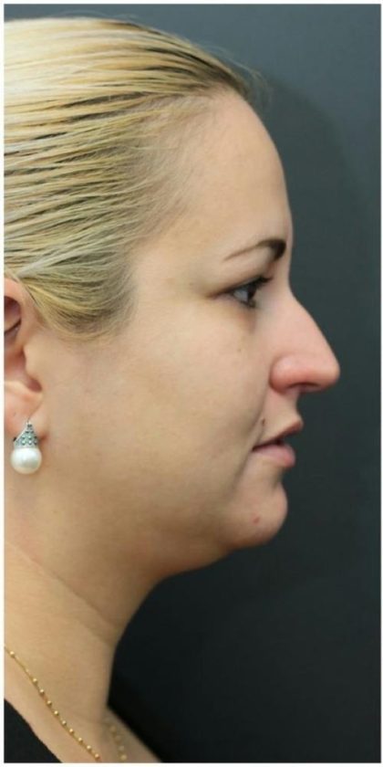 Rhinoplasty Before & After Patient #1220