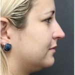 Rhinoplasty Before & After Patient #1220