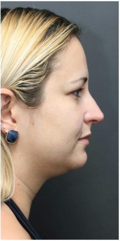 Rhinoplasty Before & After Patient #1220