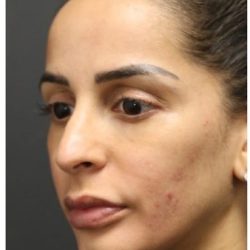 Rhinoplasty Before & After Patient #1219