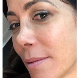 Rhinoplasty Before & After Patient #1218