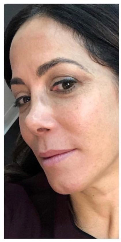Rhinoplasty Before & After Patient #1218