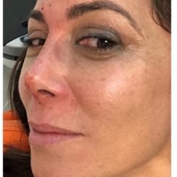 Rhinoplasty Before & After Patient #1218