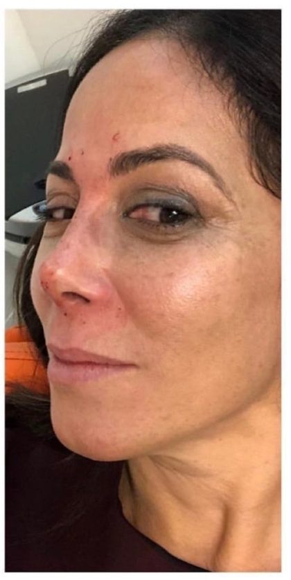 Rhinoplasty Before & After Patient #1218