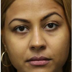Rhinoplasty Before & After Patient #1217