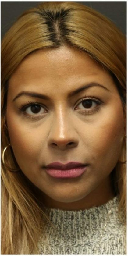 Rhinoplasty Before & After Patient #1217