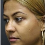 Rhinoplasty Before & After Patient #1217
