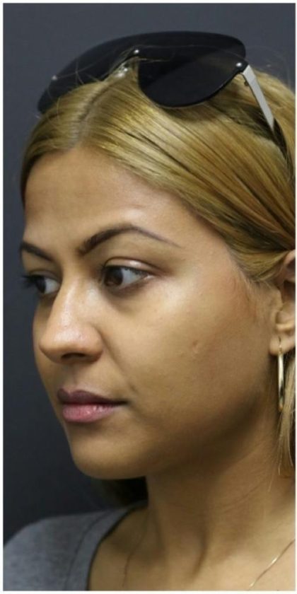 Rhinoplasty Before & After Patient #1217