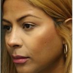Rhinoplasty Before & After Patient #1217